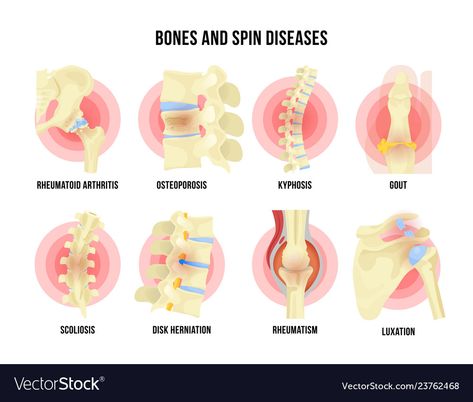 Neurofibromatosis Type 1, Bone Infection, Osteogenesis Imperfecta, Facial Bones, Disk Herniation, Bone Fracture, Bone Diseases, Strong Bones, Circulatory System