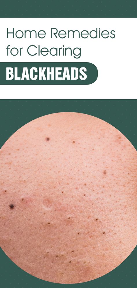 Learn about home remedies for clearing blackheads and which blackhead clearing cleanser would be good for your skin type. How To Get Rid Of Black Heads Overnight, Homemade Remedy For Blackheads, Cleanser For Blackheads, Black Head Remover Diy Homemade, Oil Cleansing For Blackheads, Homemade Black Head Remover Mask, Clearing Blackheads, Remedies For Blackheads, Home Remedy For Blackheads On Nose