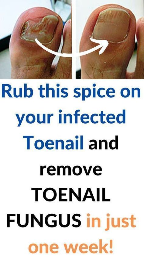 People go crazy for his recipe! toenail fungus remove in just one week!#killsnail #treatmentfungus #nailfungus #toenailfungus #fungus #fungustretment #fungustoenail Fungal Infection Remedies, Infected Toenail, Toenail Fungal Infection, Nail Remedies, Fingernail Fungus, Toenail Fungus Remedies, Nail Fungus Remedy, Nail Infection, Fungal Nail