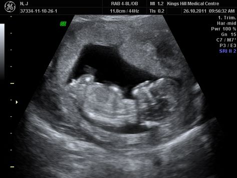 Today we went to see Mr Penman for our 12 week Nuchal Scan and screening. His clinic advises that the best time for this test is at 12.5 weeks. We went today as I thought I was 12 weeks and 4 days.... Ob Ultrasound, Gyn Ultrasound, Ultrasound School, Obstetric Ultrasound, Molar Pregnancy, Medical Sonography, Ultrasound Sonography, Medical Ultrasound, Diagnostic Medical Sonography