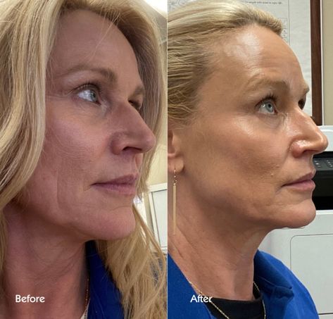 Facial balancing with fillers ⚖️ In other words, treating the face as a whole to keep everything harmonized. Signs that facial balancing might be for you?!👇🏼 • you want to create balance & improve symmetry • you want to get fillers but are afraid of looking overfilled or unnatural • you want to address volume loss in areas like under eyes, smile lines, or jowls • • • #facialbalancing #facialrejuvenation #balance #injectables #cosmetics #nurseinjector #michiganmedspa #michigandermatology... Facial Balancing, Eyes Smile, Smile Lines, Facial Rejuvenation, Under Eyes, Med Spa, Dermatology, The Face, Facial