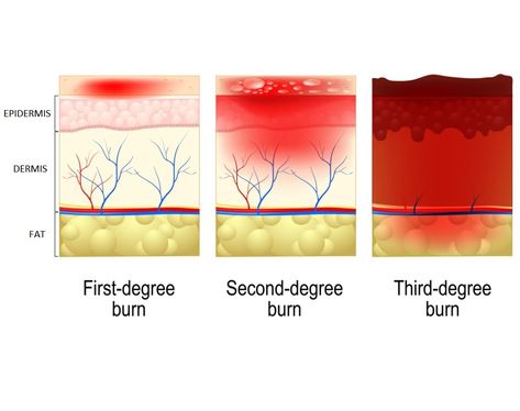 Burn Injury, Degree Burns, Severe Burns, Skin Grafting, Good Burns, Infection Control, Personal Injury Lawyer, Take Care Of Your Body, Insurance Agency