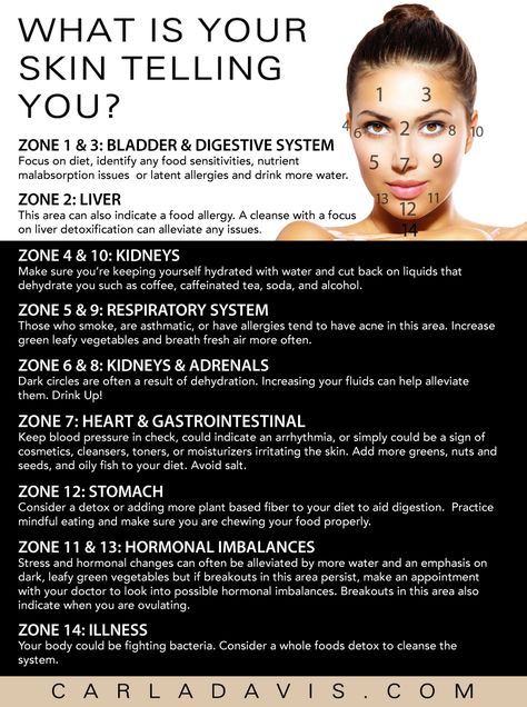 Have you ever noticed how you get blemishes on your chin around that certain time of month? Face mapping is a form of skin analysis that can help us understand the possible causes for these breakouts and do something about it. #skin #beautytip Pimples On Neck, Doterra Acne, Chin Acne Causes, Cheek Acne, Neck Acne, Chin Acne, Skin Analysis, Back Acne, Face Mapping Acne