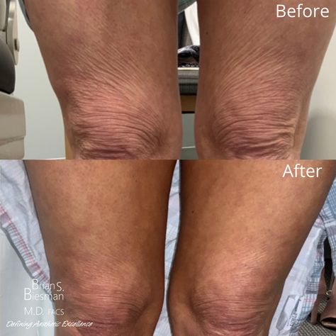 Hip Filler Before And After, Radiesse Before After, Skin Tightening Procedures, For Skin Tightening, Home Remedies For Skin, Injectables Fillers, Excess Skin, Crepey Skin, The Patient