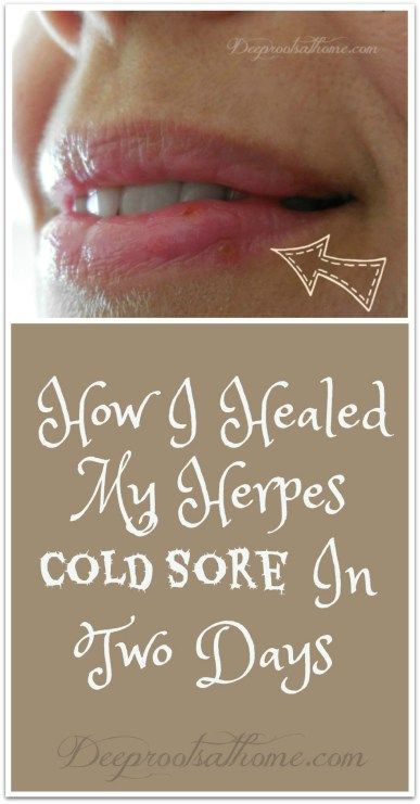 This resulted in the cold sore drying up within the first 18 hours! #essentialoils #naturalliving #coldsoreremedy Cold Remedy Tea, Natural Cold Sore Remedy, Cold Remedy, Cold Sores, Canker Sore, Cold Sores Remedies, Natural Cold Remedies, Cold Home Remedies, Cold Sore