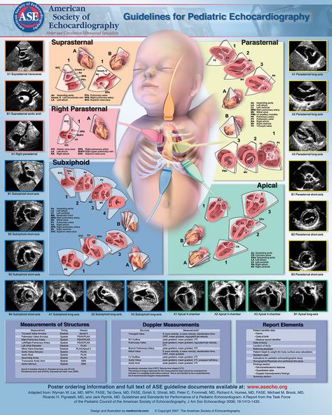 ASE_Poster4_24x30_cmyk Pediatric Echocardiography, Sonogram Technician, Ekg Leads, Cardiac Sonography, Sonography Student, Ultrasound Sonography, Diagnostic Medical Sonography, Ultrasound Technician, Company Letterhead