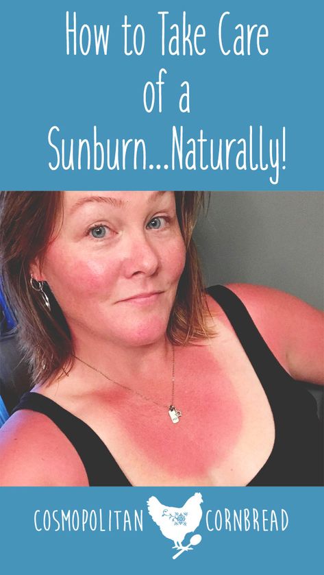 Nature, Bath For Sunburn Relief, Remedies For Sunburn Skin, Remedies For Sunburn Face, Homemade Sunburn Relief, What Helps With Sunburns, Tips For Sunburn, Diy Sunburn Remedies, How To Help Sunburn On Face