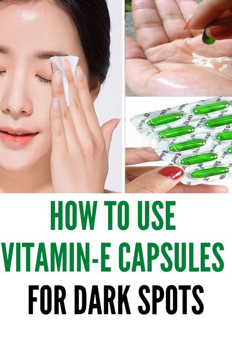 Vitamin E oil is derived from vitamin E, and you can directly apply it on your skin, can consume it, or even apply it on your hair. Many companies make vitamin E supplements and also products that contain vitamin E. So, let us have a look at some of the benefits of vitamin e capsules and uses. #darkspots #face #vitamine Beautiful Tips For Face, Use Of Vitamin E Capsule For Face, Vitamin E Benefits For Skin, Uses Of Vitamin E Capsules For Skin, Vitamin E Capsules For Face How To Use Vitamin E Capsules For Face, Vitamin E On Face, How To Use Vitamin E Capsules For Face, Vitamin E Capsules For Hair, Vitamin E Oil Uses