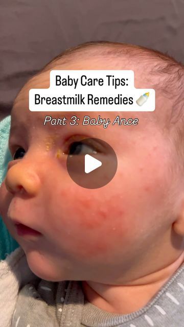 Helen on Instagram: "Details! ✨👇

Baby acne may catch new parents off guard, but here’s the magical part—those tiny bumps can heal on their own, and fast! ✨ while baby acne is not painful, it is understandable to want to heal it as fast as possible! 

Breastmilk, nature’s ultimate remedy, can speed up the healing process. 💧 Rich in antibodies and nutrients, dabbing a bit of breastmilk on the acne helps reduce redness and calm irritation—soothing that delicate skin in the gentlest way possible. It’s like a magical potion you already have, working wonders while being completely safe for your little one. 🍼

As your baby grows, their skin will keep showing off its incredible ability to regenerate. 🙌 Whether it’s acne, rashes, or little skin bumps, their body is hard at work, healing in rec Baby Acne Remedy Breastmilk, Baby Acne Remedy, Baby Rash On Face, Newborn Acne, Rash On Face, Magical Potion, Baby Acne, Clean Blackheads, Skin Bumps