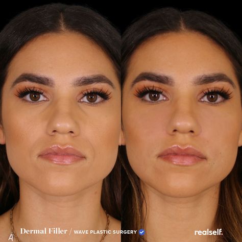 Both Juvéderm and Restylane fillers can treat nasolabial folds, also known as laugh lines. Nasolabial Fold Filler, Under Eye Fillers, Face Fillers, Hyaluronic Acid Fillers, Tear Trough, Botox Face, Cheek Fillers, Wrinkle Remedies, Facial Fillers