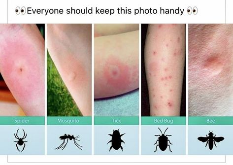 Bug bites | Useful life hacks, Identifying bug bites, Survival skills life hacks Survival Skills Life Hacks, Survival Life Hacks, Bug Bites, Survival Life, Teen Life Hacks, Everyday Hacks, Amazing Life Hacks, Simple Life Hacks, Health And Beauty Tips