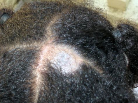 Tinea capitis (scalp ringworm): Causes, symptoms, and treatments Dandruff Causes, Scalp Problems, Hairstyle Tips, Bald Spot, Pelo Afro, Lost Hair, Scalp Conditions, Hair Food, Dry Scalp