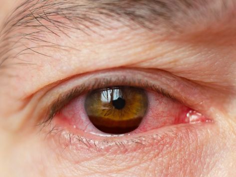 Hyphema (Bleeding in Eye): Diagnosis, Symptoms & Causes Chronic Dry Eye, Dry Eyes Causes, Dry Eye Symptoms, Eye Problems, Eye Infections, Dry Eye, Watery Eyes, Nasal Spray, Everyday Health