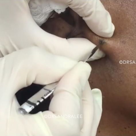 Sandra Lee, MD, FAAD, FAACS on Instagram: “When your own cyst turns you into a #popaholic 😂 Watch ‘A Popaholic Conversion Cheek Cyst’ up on YouTube & All Access now! #linkinbio…” Blackheads Popping Videos Black Heads, Removing Pimples, Blackheads On Cheeks, Big Zits, Squeezing Blackheads, Cystic Pimple, Diy Facial Mask, Pimples Under The Skin, Zit Popping Videos