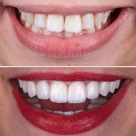 How I Healed My Teeth Naturally: Dental Secret To Rebuild Gums, Get Rid of Tooth Decay and Cavities.#toothdecay,#toothproblem,#dentist,#receding,#OralHygieneCare,#WhatAreOralCare,#WhatIsOralCare,#HowToCareForOralHealth,#OralDentalCare,#teeth #HealthTips #SelfCare #NutritionTips #FitLife #Wellness #HealthyLiving #FitnessTips #HealthyLifestyle Grow Back Receding Gums, Dental Pictures, Whiten Teeth Fast, I Healed, Tooth Decay Remedies, Teeth Whitening Homemade, Veneers Teeth, Teeth Whitening Remedies, Grills Teeth