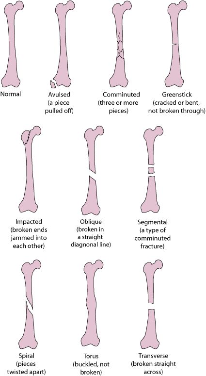 Some Types of Fractures Facial Bones Anatomy, Rad Tech Student Notes, Fracture Types, Rad Tech Student, Types Of Fractures, Medical Diagrams, Human Anatomy Study, Medical Terminology Study, Types Of Injuries