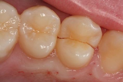 Cracked teeth, what will happen with future lasers where we can scan and repair cracked pathogens Deep Teeth Cleaning, Cracked Tooth, Tooth Infection, Dental Bonding, Tooth Filling, Dental Fillings, Dental Emergency, Teeth Implants, Dental Procedures