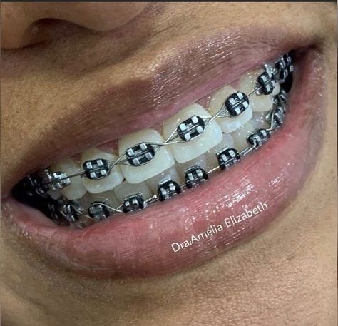 Braces Black Color, Braces With Black Bands, Black Braces Power Chain, Braces Colors Black, Black Braces Aesthetic, Braces Aesthetic Girl, Black Braces Teeth, Aesthetic Braces, Black Braces Bands