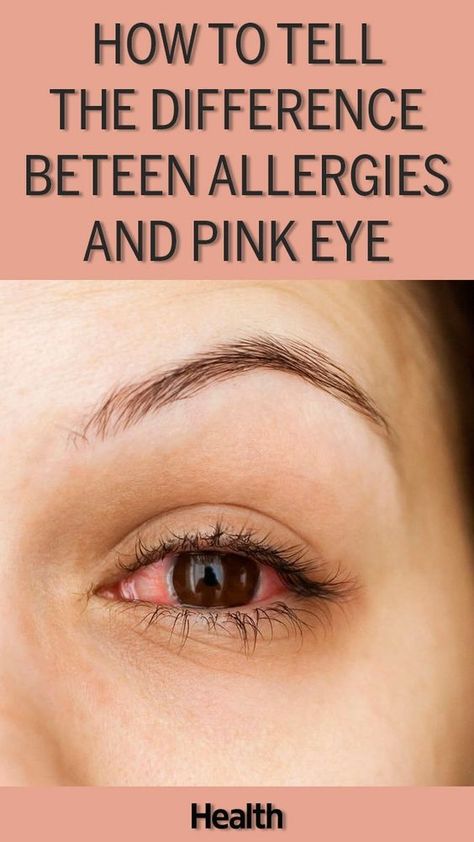 How to Tell the Difference Between Allergies and Pink Eye Eye Irritation Remedies, Itchy Eyes Remedy, Treating Pink Eye, Goopy Eyes, Eye Allergy Relief, Swelling Remedies, Pinkeye Remedies, Allergy Eyes, Home Remedies For Allergies