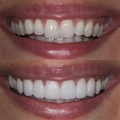 Teeth Makeover, Pretty Teeth, Veneers Teeth, Beautiful Teeth, Loose Tooth, Porcelain Veneers, Teeth Shape, Perfect Teeth, Dental Veneers