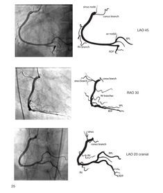 Coronary Angiography Views, Aorta Anatomy, Cath Lab Nursing, Cardiac Cath, Cath Lab Nurse, Coronary Circulation, Heart Catheterization, Arteries Anatomy, Cardiology Nursing