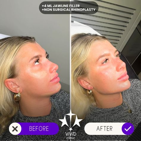 💉✨ Sculpt and define your face with Jawline Filler at Vivid Clinic! Check out this stunning Client Transformation—perfectly contoured, sharper jawline for a more defined and balanced appearance. 💎 ✅ Enhances facial definition ✅ Non-surgical with immediate results ✅ Long-lasting, natural-looking transformation 💬 Want to achieve a similar look? Book your free consultation today and take the first step toward a more sculpted you! 📍Located in Istanbul, Turkey 🌐 vividclinic.net 📞 🇺🇸 +90 545 742... Facial Definition, Sharper Jawline, Jaw Filler, Jawline Filler, Rhinoplasty Before And After, Facial Fillers, Lip Filler, Lip Fillers, Istanbul Turkey