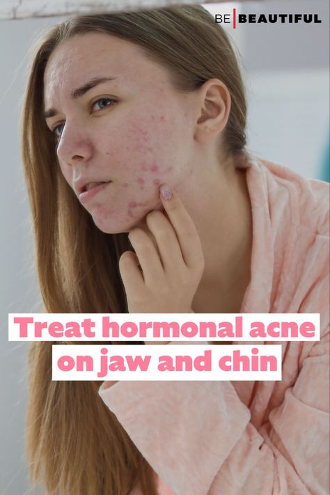 Treating hormonal acne Acne On Chin Meaning, Acne On Jawline Meaning, Treat Hormonal Acne, Cystic Acne On Chin, Jawline Acne, Neck Acne, Painful Acne, Acne Reasons, Treating Cystic Acne