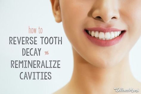 Reverse Tooth Decay, Cavity Remedy, Remineralize Teeth, Sensitive Teeth Remedy, Heal Cavities, Wellness Mama, Holistic Health Remedies, Teeth Health, Tooth Sensitivity