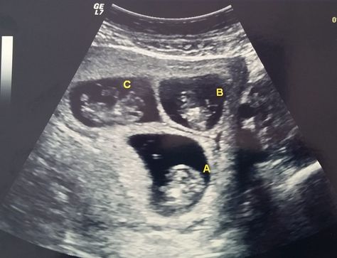 how I found out I was having triplets and also #csection #multiples #newmom Birth Story: There Are At Least Two Babies in There – Everyday Mamas Triplet Pregnancy, Triplets Pregnancy, Andrew Wood, Pregnancy Ultrasound, Bb Reborn, Wood Moon, Baby Ultrasound, Triplet Babies, Ultrasound Pictures