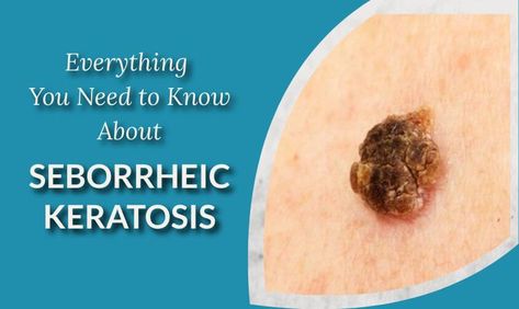 Seborrheic Keratosis 101 – Everything You Need to Know Seborrheic Keratosis, Clean Blackheads, Skin Growths, Bumpy Skin, Skin Care Wrinkles, Skin Condition, Skin Disorders, Things Under A Microscope, Hormonal Changes