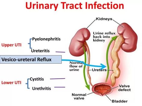 Urinary tract infections causes, types, risk factors, Upper UTI (pyelonephritis), Lower UTI (cystitis and urethritis) Protein Metabolism, Health Cleanse, Health Pictures, Urinary Tract, Health Inspiration, Health Motivation, Health Facts, Health Education, Holistic Health