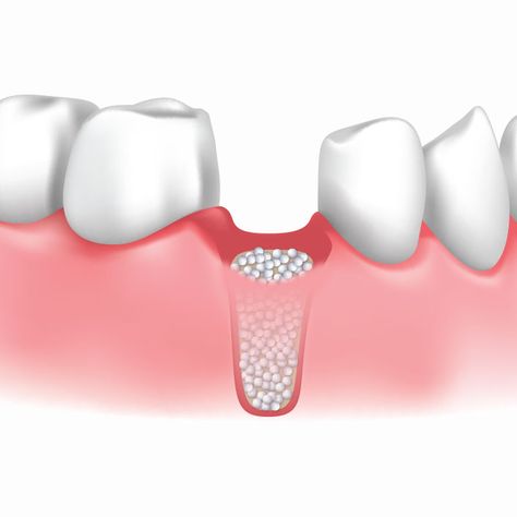 The reason that might require a Bone Graft: 1. Diseases of the bone, such as osteonecrosis. 2. Spinal fusion surgery. 3. Dental implant surgery. 4. Surgically implanted devices. For all your dental needs click on - goo.gl/Wcsebp Spinal Fusion Surgery, Bone Grafting, Dental Implant Surgery, Spinal Fusion, General Dentistry, Dental Implant, Root Canal, Dentures, Cosmetic Dentistry