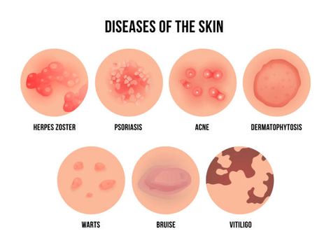 Skin Rashes Pictures, Skin Disease Pictures, Types Of Skin Rashes, Skin Logo, Types Of Skin, Natural Antibiotics, Healthy Liver, Skin Disorders, Skin Diseases