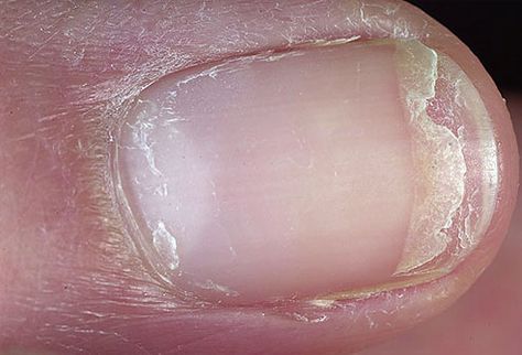 Split fingernail-Cracked or Split Nails  Dry, brittle nails that frequently crack or split have been linked to thyroid disease. Cracking or splitting combined with a yellowish hue is more likely due to a fungal infection. Nail Disorders, Do It Yourself Nails, Nail Remedies, Split Nails, Cracked Nails, Peeling Nails, Nail Infection, Weak Nails, Fungal Nail