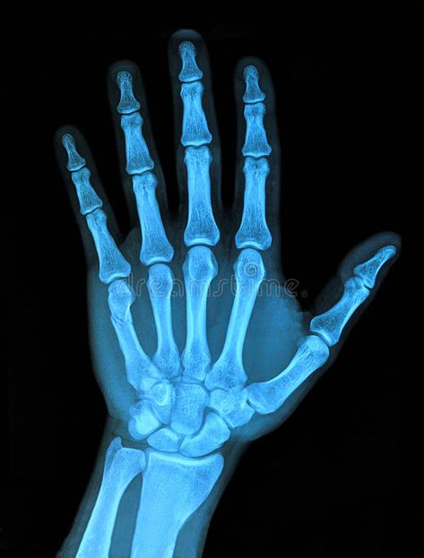 Xray hand. X-Ray Image of right hand , #ad, #hand, #Xray, #Image, #Ray #ad X Ray Aesthetic, Hand Xray, Braille Art, Glowing Skeleton, Best Hand Tattoos, Xray Art, X-ray Images, Hand Photography, Medical Background