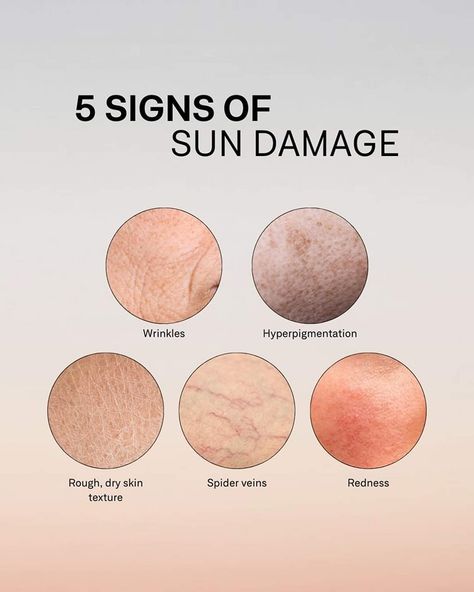 Your skin is your body’s largest organ, and it’s important to protect it! Some key signs of skin damage include dryness and flaking, redness and inflammation, wrinkles and fine lines, dark spots and hyperpigmentation, spider veins, and rough texture. Prevention is key! Make sure to wear sunscreen daily, stay hydrated, wear protective clothing, and moisturize regularly. Take care of your skin today for a healthier tomorrow! Spa Social Media Posts, Med Spa Social Media, Skin Biology, Skin Theory, Product Post Design, Holistic Facial, Esthetician Salon, Esthetician Tips, Blue Skincare