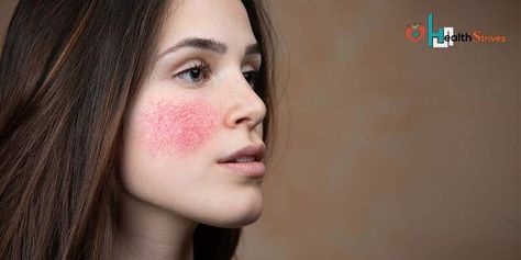 Does your face often turn red? There may be several reasons that cause redness on face. Read this post to find the reason and best solution to treat it. Reduce Face Redness, Redness On Face, Red Veins, Red Vines, Skin Diseases, Skin Skincare, Glowing Complexion, Daily Skin Care Routine, Haircuts For Women