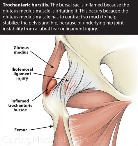 Femoroacetabular Impingement, Greater Trochanteric Pain Syndrome, Snapping Hip Syndrome, Hip Impingement, Hip Injury, Psoas Release, Bursitis Hip, Hip Fracture, Gluteal Muscles