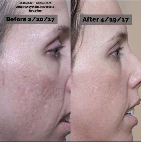 Got acne scars/pitting on your skin? These results are amazing & on point with the #1 Premium Skincare Brand!! She used our Amp MD Roller along with Intensive Renewing Serum with RetinAl. 💫 It’s only the closest thing you can get to prescription strength Vitamin A...and 💫 20X stronger than Retinol...no big deal right?! 🌟 Pair it with our REDEFINE or REVERSE regimen to amplify results on skin texture for a firmer, smoother, glowing complexion! #nomorewrinkles #wrinklefree #intensivenight Amp Md Roller, Micro Needling, Life Changing Opportunity, Premium Skincare, Glowing Complexion, Rodan And Fields, Skin Concern, Wrinkle Free, Dead Skin