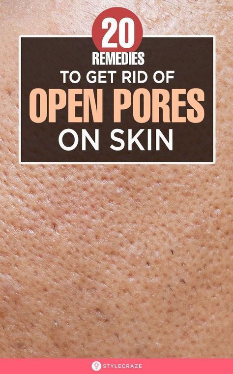 Open Pores On Face, Lotion For Oily Skin, Home Remedies For Skin, Open Pores, Baking Soda Shampoo, Moisturizer For Oily Skin, Large Pores, Skin Pores, Skin Care Solutions