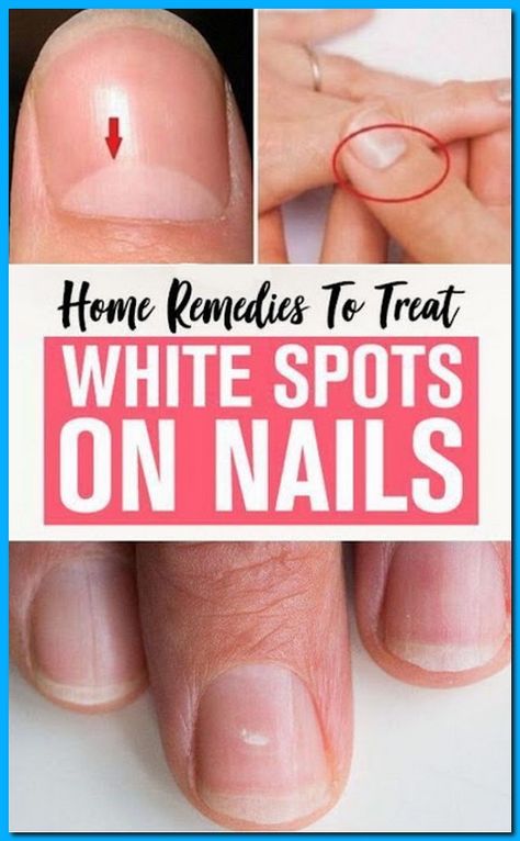 Top Home Remedies For White Spots On Finger Nails White Spots On Fingernails, White Spots On Nails, Nail Remedies, Home Medicine, Natural Beauty Remedies, Fungal Nail, Health Signs, Finger Nails, Striped Nails