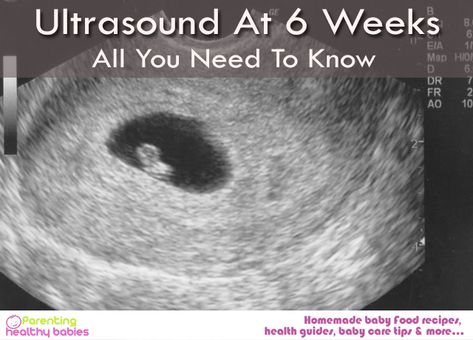 #6weeks, #6weeksultrasound, #6weekspregnancy, #UltrasoundDuringWeek6 Ultrasound By Week, Pregnant 6 Weeks, 6weeks Pregnant Ultrasound, 5 Weeks Pregnant Symptoms, Week 6 Of Pregnancy, Twin Ultrasound 6 Weeks, 6weeks Pregnant, 6 Week Ultrasound Pictures, 5 Week Ultrasound Pictures