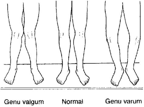 Recently I have been experiencing slight pain after hamstring exercises in the inside of my knees.    Tonight I trained hamstrings and paid close attention to my form to ascertain any potential problems. One thing I noticed is that durring my rack pulls and leg curls my knees (and lower leg) angle inwards. To illustrate, imagine you are standing and doing a quad stretch (bringing your heel to your ass). Instead of my heels each finishing towards the outside of each glute, they travel slightly... Genu Valgum, Genu Varum, Bow Legged Correction, Knock Knees, Bow Legged, Hamstring Workout, Musculoskeletal System, Skeletal Muscle, Body Systems