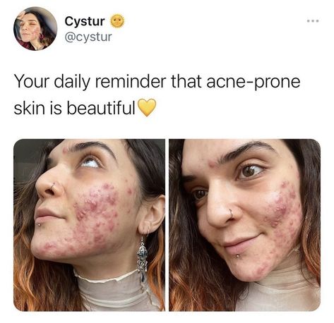 Acne Acceptance, Normalize Acne, Acne Appreciation, Acne Is Normal, Acne Aesthetic, Acne Photos, Acne Positivity, Acne Women, Skin Positivity