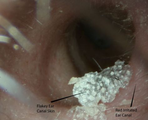 Itchy ears are a very common problem. For some people the problem is so bad that they stick various objects... Read the full article... Itchy Ears Causes, Itchy Inner Ear Relief, Itchy Ear Canal Remedies, Itchy Ears Remedies, Clogged Ears, Ear Diseases, Inside Ear, Ear Problems, Itchy Ears