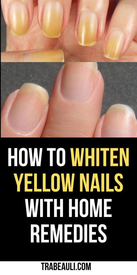 how to whiten yellow nails Stained Nails From Nail Polish, How To Whiten Yellow Nails, How To Whiten Toenails, How To Clean Yellow Nails, How To Whiten Your Nails, How To Get White Nails, Toenail Whitening, Strong Nails Diy Remedies, Yellow Natural Nails