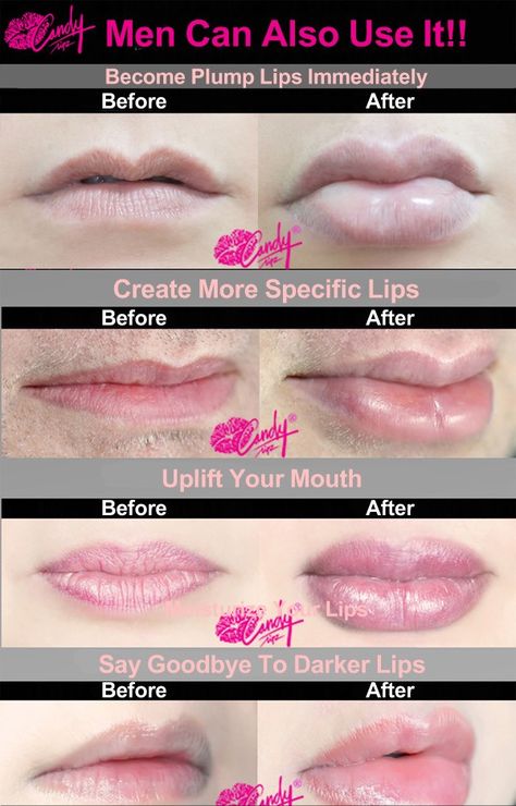 Before and after lip plumper, lip plumper device, CandyLipz lip plumper device #makeup #lips #lipplumper #tutorial #beauty Diy Lip Plumper, Lip Plumper Device, Salt Face Scrub, Face Scrub Recipe, Plumper Lips, Drugstore Lips, How To Get Bigger, Plump Lips, Makeup Lips