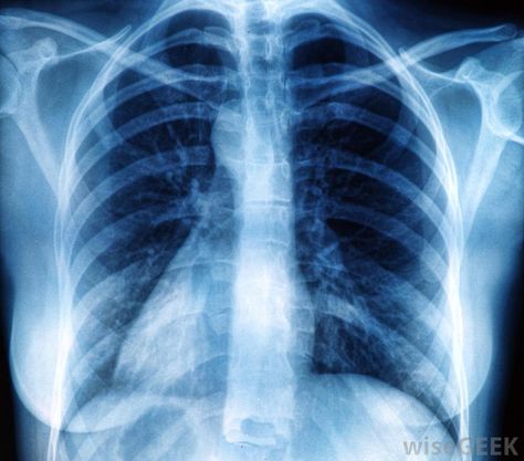 Human Rib Cage, Xray Art, Skeleton Body, Radiology Imaging, How To Help Nausea, Aesthetic Space, Pregnancy Health, Medical Aesthetic, Rib Cage