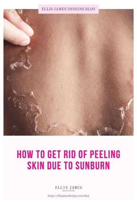 If you are struggling with your skin peeling, make sure to look at the reasons and recommendations in this post. | How to Stop Peeling Skin: Ways to Stop Peeling Once It Starts | Peeling Skin: Natural Ways to Get Rid of Peeling Skin Fast | How to get rid of peeling skin immediately | Why Does My Skin Peel? How to Get Rid of Skin Peeling | How to Exfoliate Peeling Skin | Should you exfoliate peeling skin? | #founditonamazon #skinpeeling #skincaretips #beautytips #skintips Skin Peeling From Sunburn, Lip Pimple, Dry Peeling Skin, Get Rid Of Sunburn, Sunburn Peeling, Skin Peel, Sunburn Remedies, Pimples Under The Skin, Face Peel