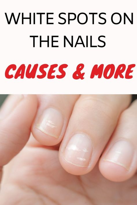 White Dots On Nails, White Spots On Fingernails, White Lines On Nails, White Marks On Nails, White Spots On Toenails, White Spots On Nails, Nail Signs, Nail Infection, Fungal Nail